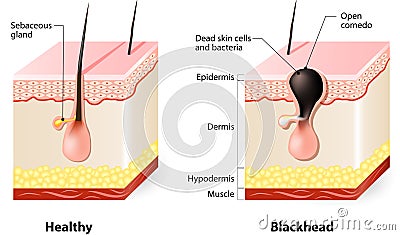 Healthy skin and Blackheads Vector Illustration