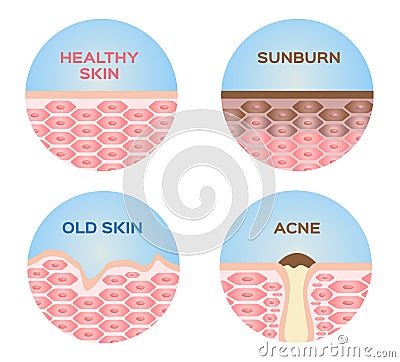 Healthy skin , sunburn , old skin and acne 4 set Vector Illustration