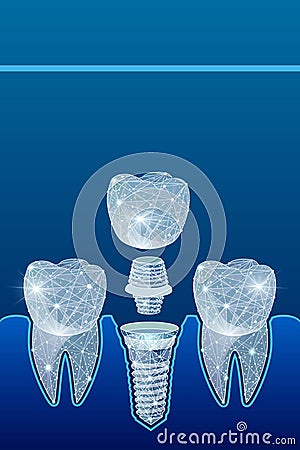 Healthy teeth and dental implant. Dentistry. Implantation of human teeth. illustration Cartoon Illustration