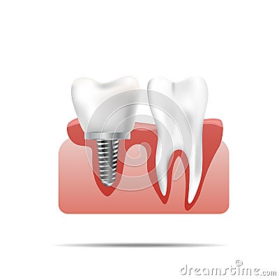 Healthy teeth and dental implant. Realistic illustration of tooth medical dentistry. Vector Illustration