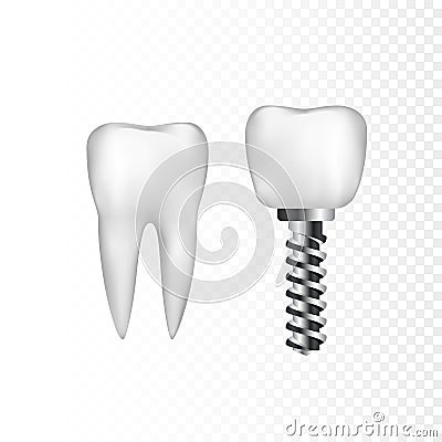 Healthy white tooth and implant with steel screw. Dentistry and dentist care. Vector illustration isolated on transparent Vector Illustration