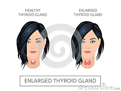 Female with normal and enlarged thyroid gland Stock Photo