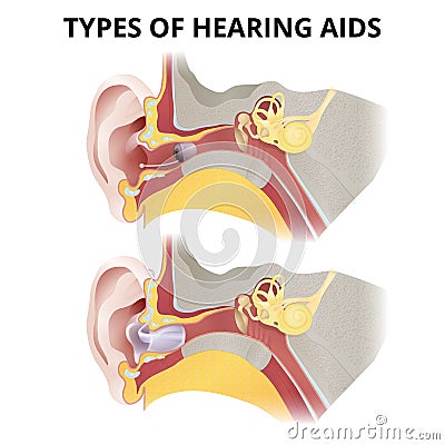 Hearing aid, in-ear sectional view, different types of devices Stock Photo