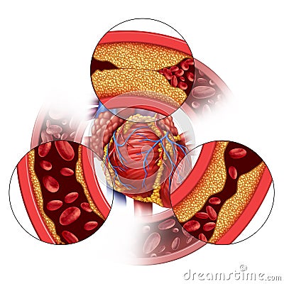 Heart Artery Disease Cartoon Illustration