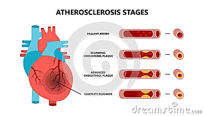 Heart attack and atherosclerosis stages. Healthy artery, beginning cholesterol plaque, advanced cholesterol plaque Vector Illustration