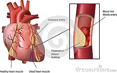 Heart Attack Caused by Cholesterol Vector Illustration