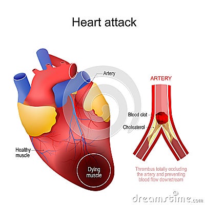 Heart attack. myocardial infarction Vector Illustration