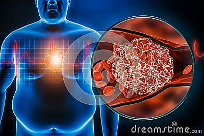 Heart attack or stroke 3D rendering illustration. Fat or obese man chest body with stemi ekg and blood clot. Obesity, healthcare, Cartoon Illustration