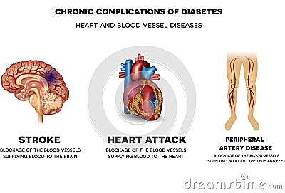 Heart and blood vessel diseases Vector Illustration