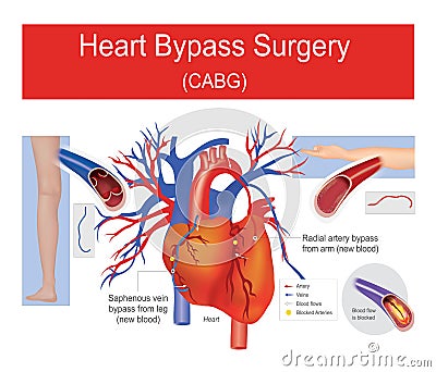 Heart bypass surgery. Stock Photo