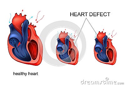 Heart disease. defect Vector Illustration