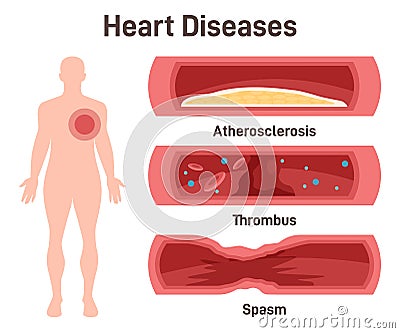 Heart disease set. Atherosclerosis, thrombus, coronary artery spasm Vector Illustration