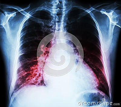 Heart failure ( film x-ray chest PA upright : show cardiomegaly and interstitial infiltrate both lung ) Stock Photo