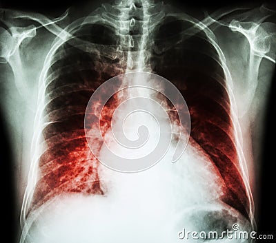 Heart failure ( film x-ray chest PA upright : show cardiomegaly and interstitial infiltrate both lung ) Stock Photo
