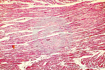 Heart hypertrophy photomicrograph Stock Photo