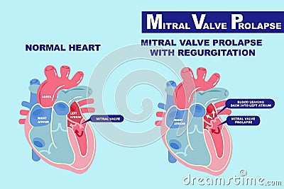 Heart with mitral valve prolapse Vector Illustration