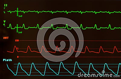 Heart Monitor with Intraventricular Conduction Delay on EKG Stock Photo