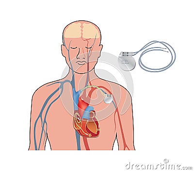 Heart pacemaker in work. Human heart artificial cardiac, ICD Stock Photo