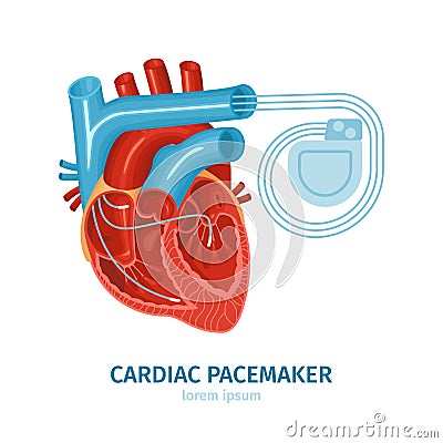 Heart Pacemaker Illustration Cartoon Illustration