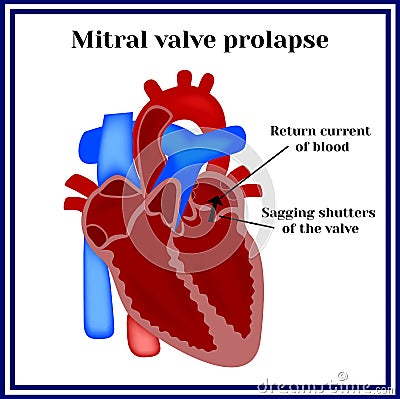 Heart structure. Mitral valve prolapse. Cardiac pathology Vector Illustration