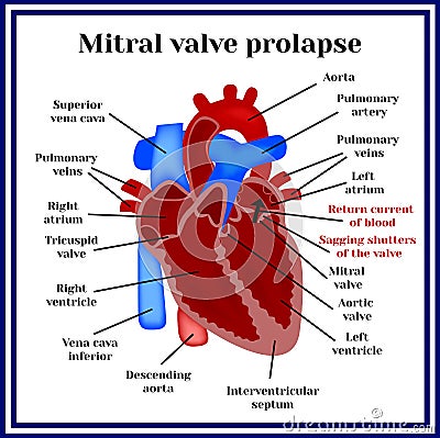 Heart structure. Mitral valve prolapse. Cardiac pathology Vector Illustration