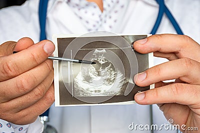 Heart ventricular dilation on ultrasound image concept photo. Doctor indicating by pointer on printed picture of ultrasound pathol Stock Photo