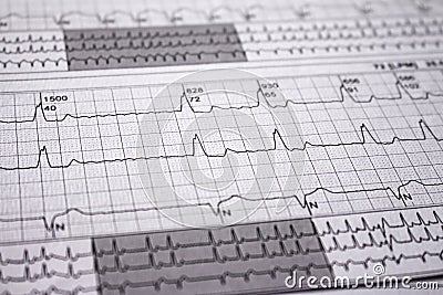 Heartbeat represented on paper. Cardiac arrhythmias. Selective focus on some beats. Atrial fibrillation Intraventricular Stock Photo