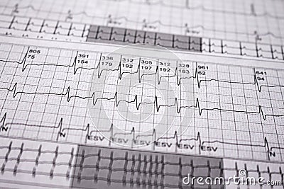 Heartbeat represented on paper. Cardiac arrhythmias. Selective focus on some beats. Supra ventricular tachycardia. Free space to Stock Photo