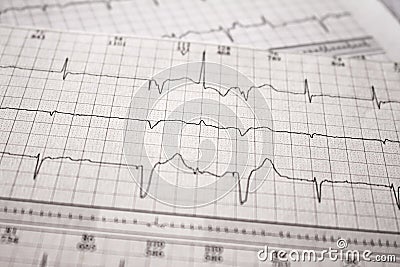 Heartbeat represented on paper. Electrocardiogram of patient with pacemakers with malfunction. Failure of sensing of extra systole Stock Photo