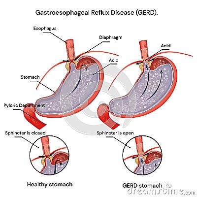 Heartburn and Gastroesophageal Reflux. Disease (GERD). Acid reflux. Cartoon Illustration