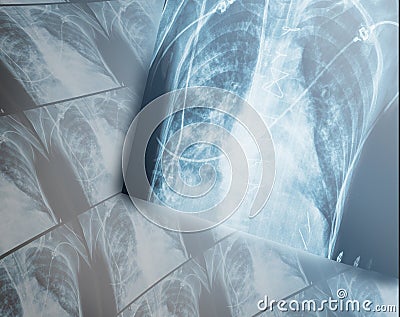 Heavy destructive changes in the lungs of the patients x-ray. Stock Photo