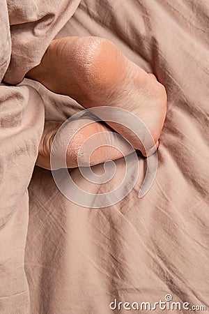 heel in the cracks of the smears on the legs feet treatment leg, lotion bad rough disease dermatitis, sole callosity Stock Photo