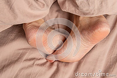 heel in the cracks of the smears on the legs care, heels skin white dermatitis, close moisturizer. athletes Stock Photo