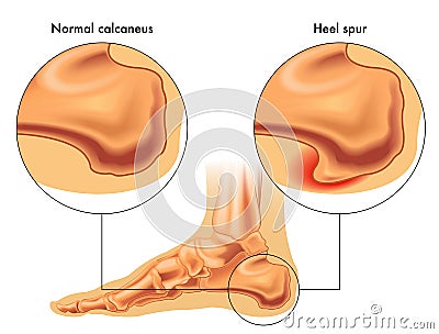 Heel spur Vector Illustration