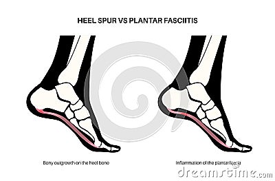 Heel spur and plantar fasciitis Vector Illustration