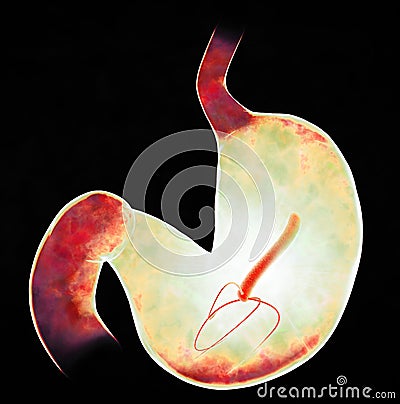 Helicobacter pylori is a gram-negative, flagellated, helical bacterium. Stomach mucosa Stock Photo