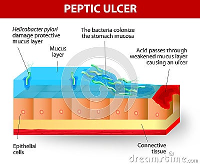 Helicobacter pylori and ulcers disease Vector Illustration