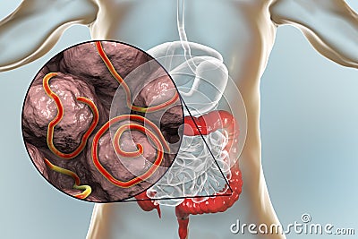 Helminths nematodes Enterobius in the gut Cartoon Illustration