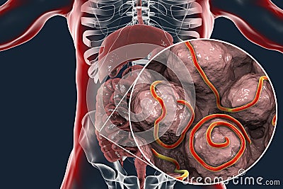 Helminths nematodes Enterobius in the gut Cartoon Illustration