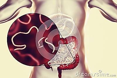 Helminths nematodes Enterobius in the gut Cartoon Illustration