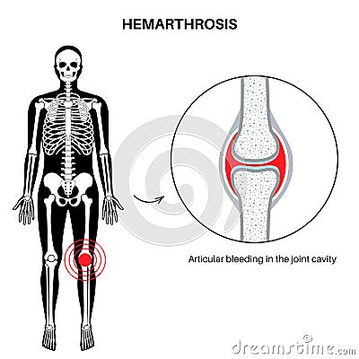 Hemarthrosis in the synovial joint Vector Illustration