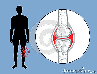 Hemarthrosis in the synovial joint Vector Illustration