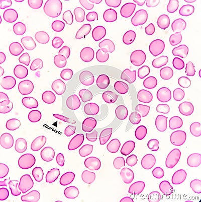 Hematological slide showing Elliptocyte, abnormal RBC, Iron deficiency anemia. Pencil cell. Stock Photo