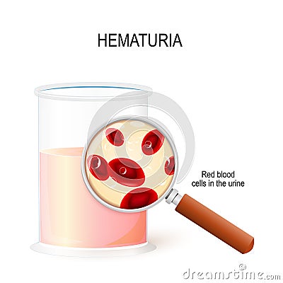 Hematuria. magnifying glass and beaker with urine. Closeup of Red blood cells Vector Illustration