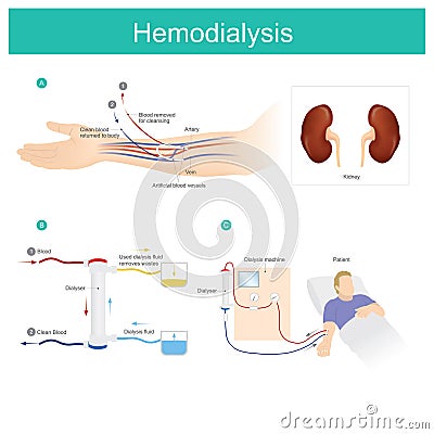 Hemodialysis. Patient blood is put through a filter outside your Stock Photo