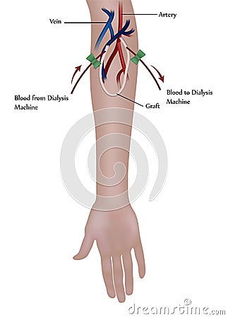 Hemodialysis procedure Vector Illustration