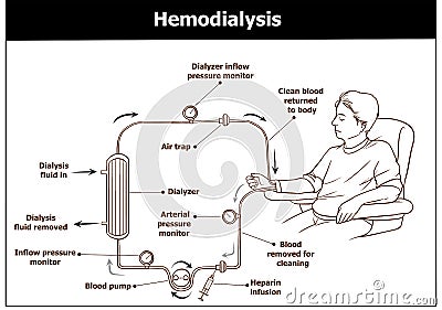 Hemodialysis procedure. Used for the renal insufficiency. Vector Illustration