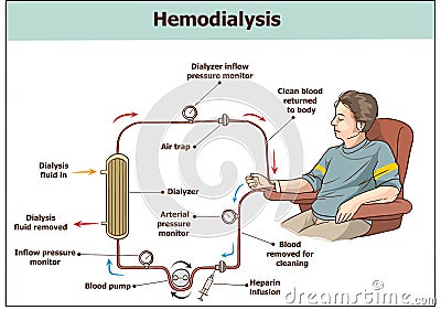 Hemodialysis procedure. Used for the renal insufficiency Vector Illustration