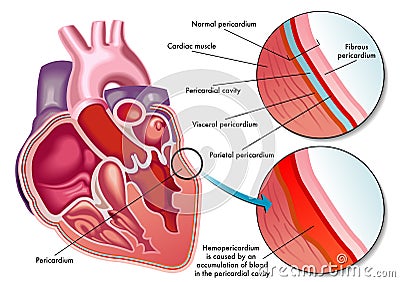 Hemopericardium Vector Illustration