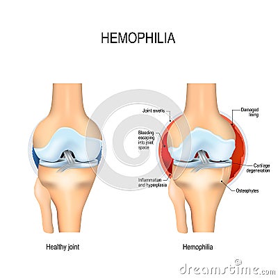 Human knee with hemophilia and healthy joint Vector Illustration